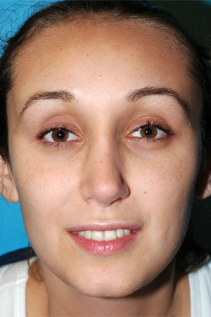 Richard Davis, MD Revision Rhinoplasty: Patient 2, Front View, Post-Op