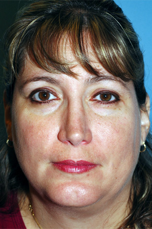 Richard Davis, MD Revision Rhinoplasty: Patient 3, Front View, Post-Op