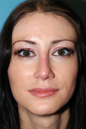 Richard Davis, MD Revision Rhinoplasty: Patient 4, Front View, Post-Op