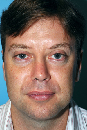 Richard Davis, MD Revision Rhinoplasty: Patient 5, Front View, Post-Op