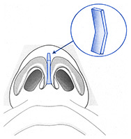 Glossary Of Terms Commonly Used In Primary Revision Rhinoplasty Glossary Of Terms Commonly Used In Primary Revision Rhinoplasty
