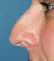 Tension Nose Deformity with Pollybeak and Overprojected Tip