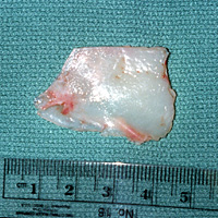 Harvested Septal (Nasal Septum) Cartilage