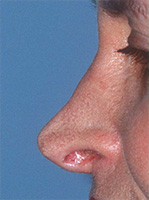 Excessive Nostril Visibility from Overly Aggressive Excisional Rhinoplasty