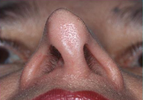 Assymmetry from Overly Aggressive Excisional Rhinoplasty
