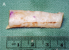 Harvested Costal (Rib) Cartilage Before Carving